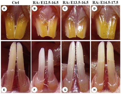 Retinoic Acid Excess Impairs Amelogenesis Inducing Enamel Defects